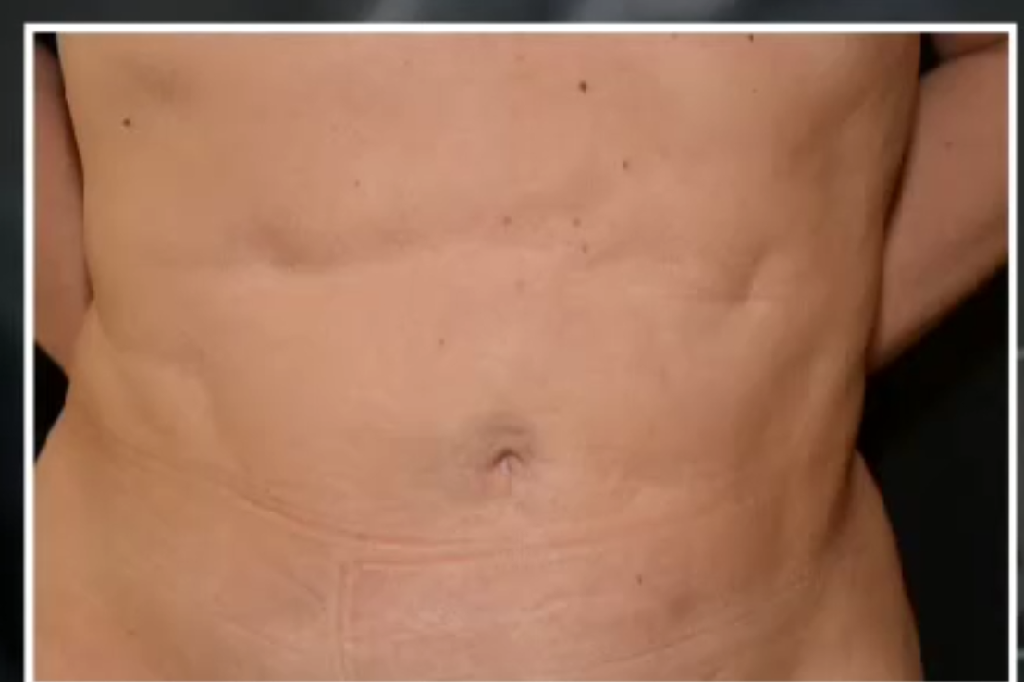 Laser, Botox, Skönhetsindustrin, Fettsugning