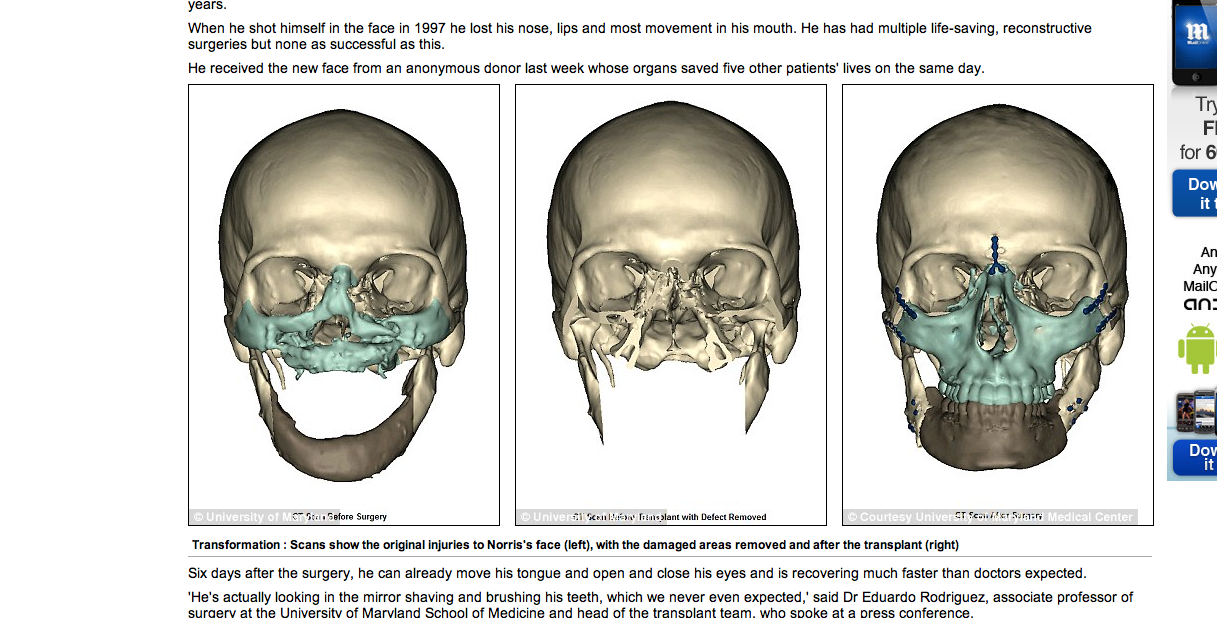 Skador, Olycka, Transplantationer, University of Maryland, Ansikte, USA