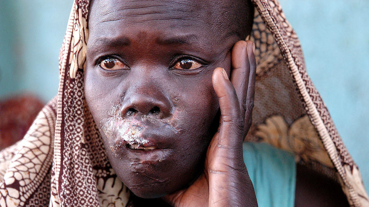 Kvinna som behandlas efter torterats av LRA.