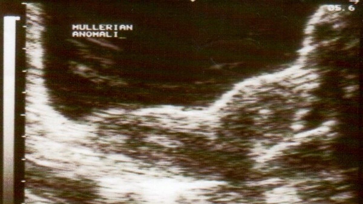 Här kan man se ett ultraljud på en person som har dubbla vaginor.