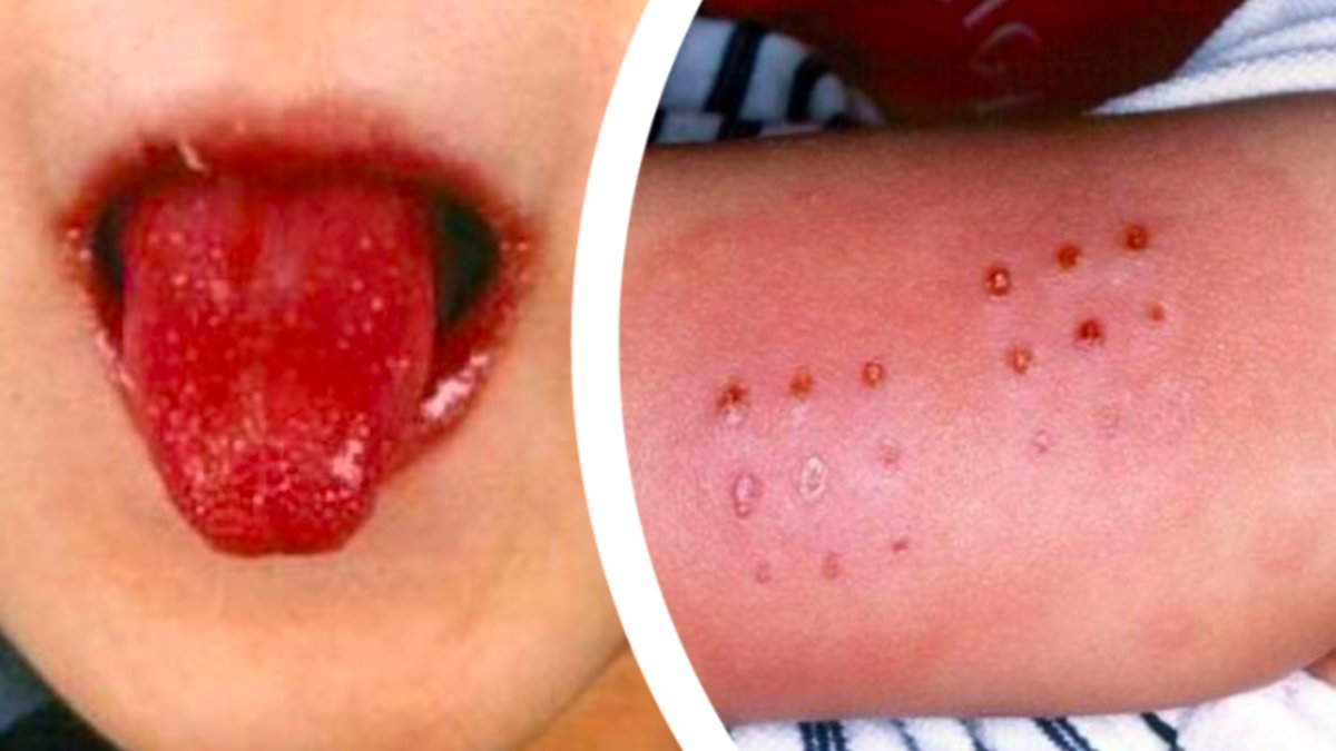 Mystiska hudsjukdomen i sviterna av corona – 100 barn insjuknade 