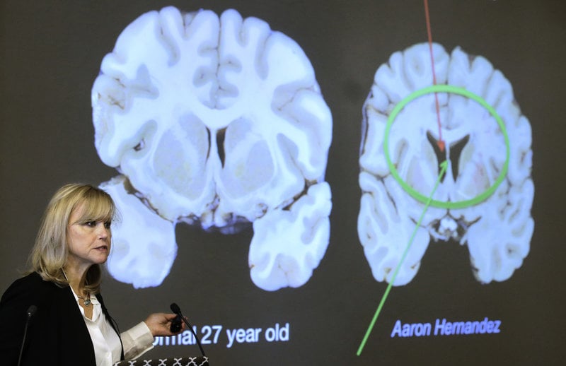 Ann McKee från Boston University visar på skillnaden mellan en normal hjärna och en CTE-drabbad. Bilden togs vid en föreläsning 2017, och har alltså inte direkt med det nu aktuella fallet att göra.
