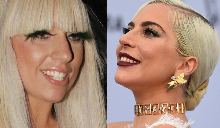 Lady Gaga före och efter operationerna.