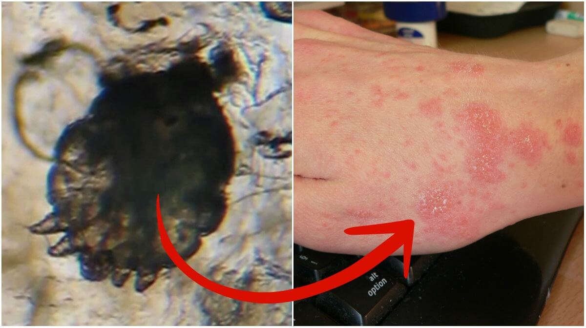 Så vet du om du har fått skabb och här är knepet för att