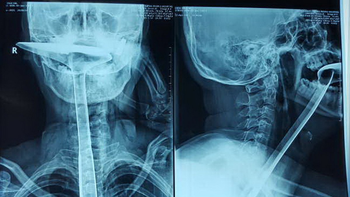 Det här röntgenbilden visar en 30 centimeter lång stekspade i halsen. Hon försökte klara strupen när stekspaden fastnade.