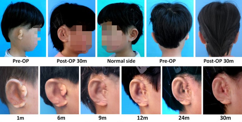 Örontransplantation Örontransplantation