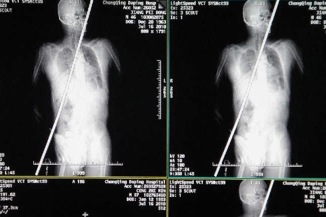 Här är röntgenbilderna av Lucky Lu. Varning för starka bilder i bildspelet. 