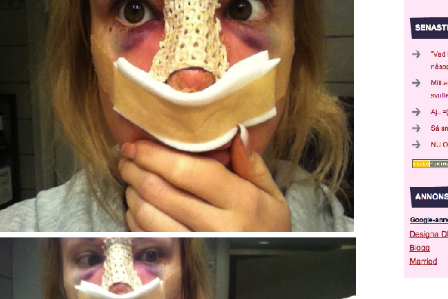 Här visade Alexandra upp ett svullet ansikte i bloggen. Det efter att hon skulpterat om sin näsa.