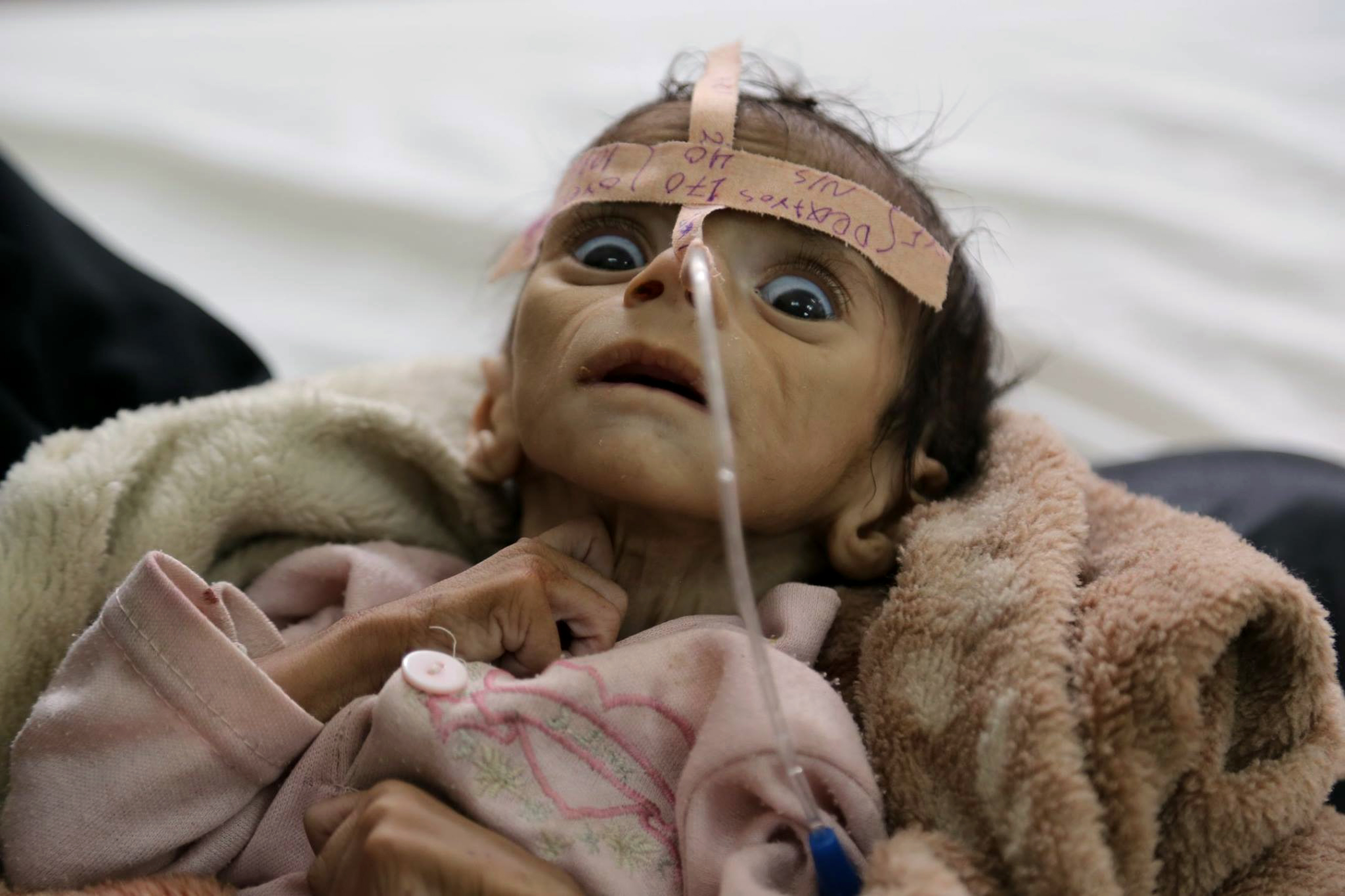 Svält, Pojke, Jemen