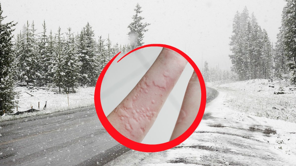 En väg omringad av träd med mycket snö. En arm med utslag i en rund röd ring.