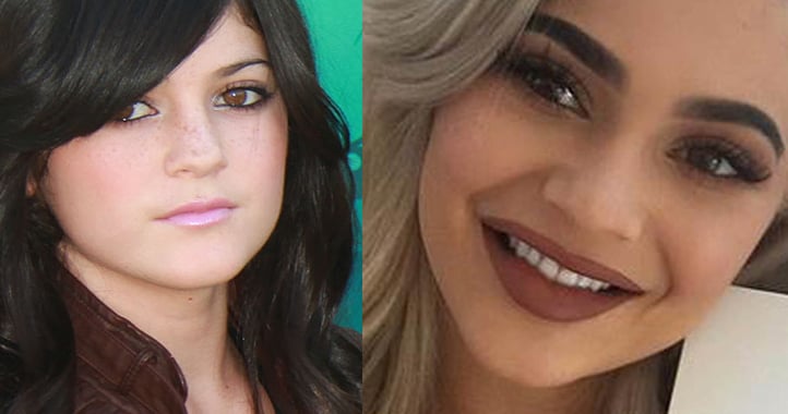 Kylie Jenner före och efter sina operationer.