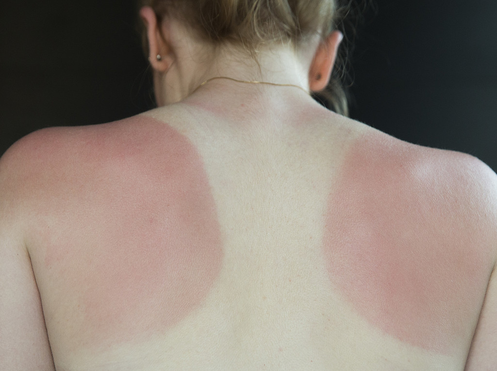 Bränna sig i solen Bränna sig i solen