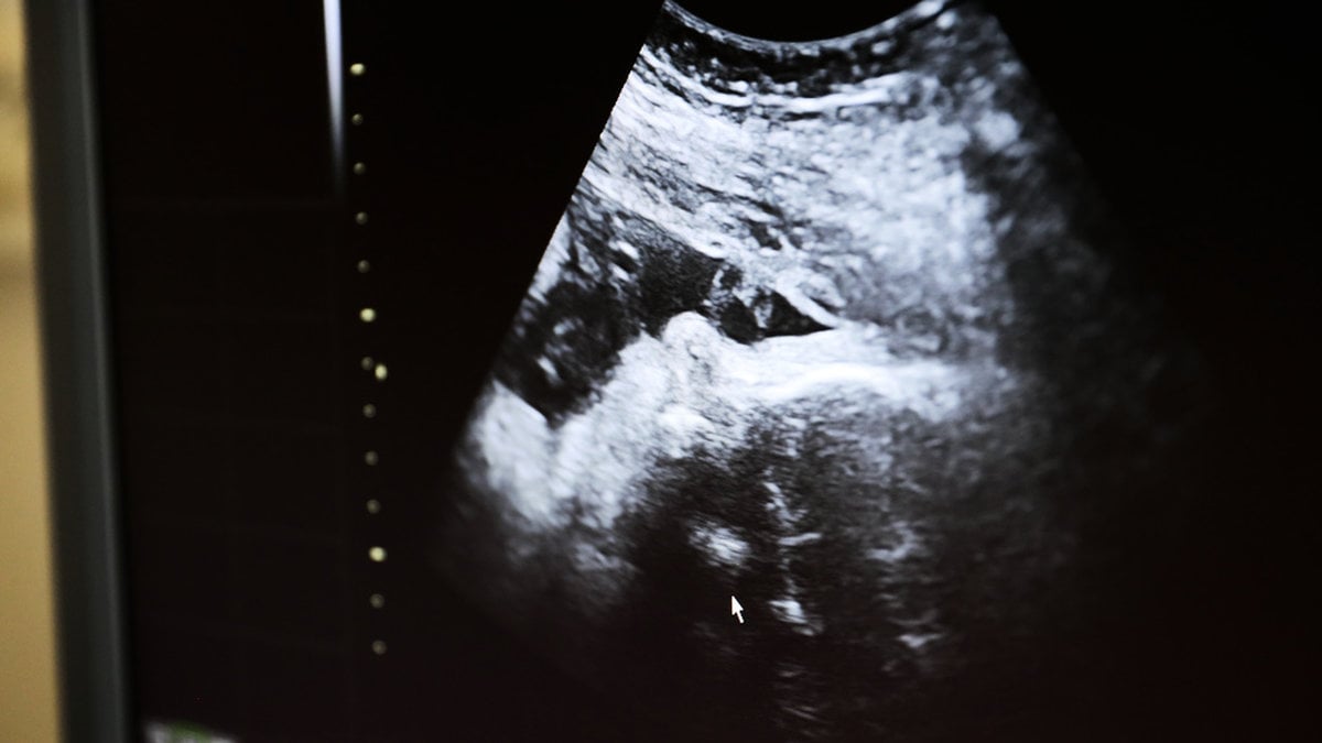 Vanliga KUB-testet försvinner – ersätts av träffsäkrare NIPT