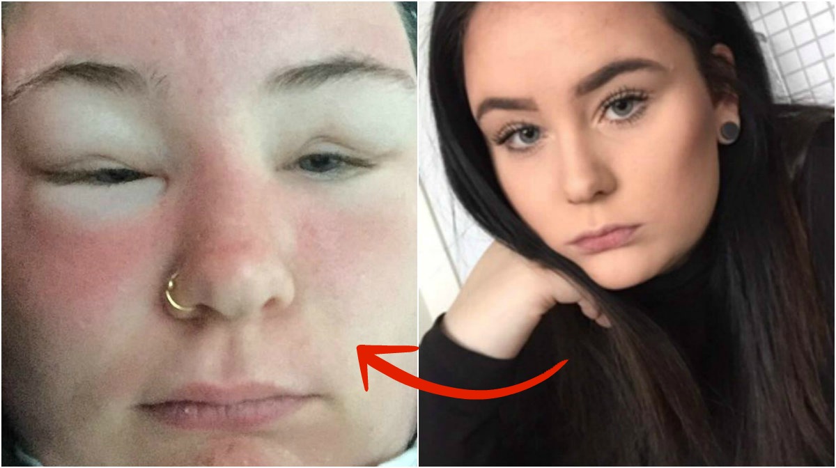 Julia, 17, glömde något viktigt när hon solade: