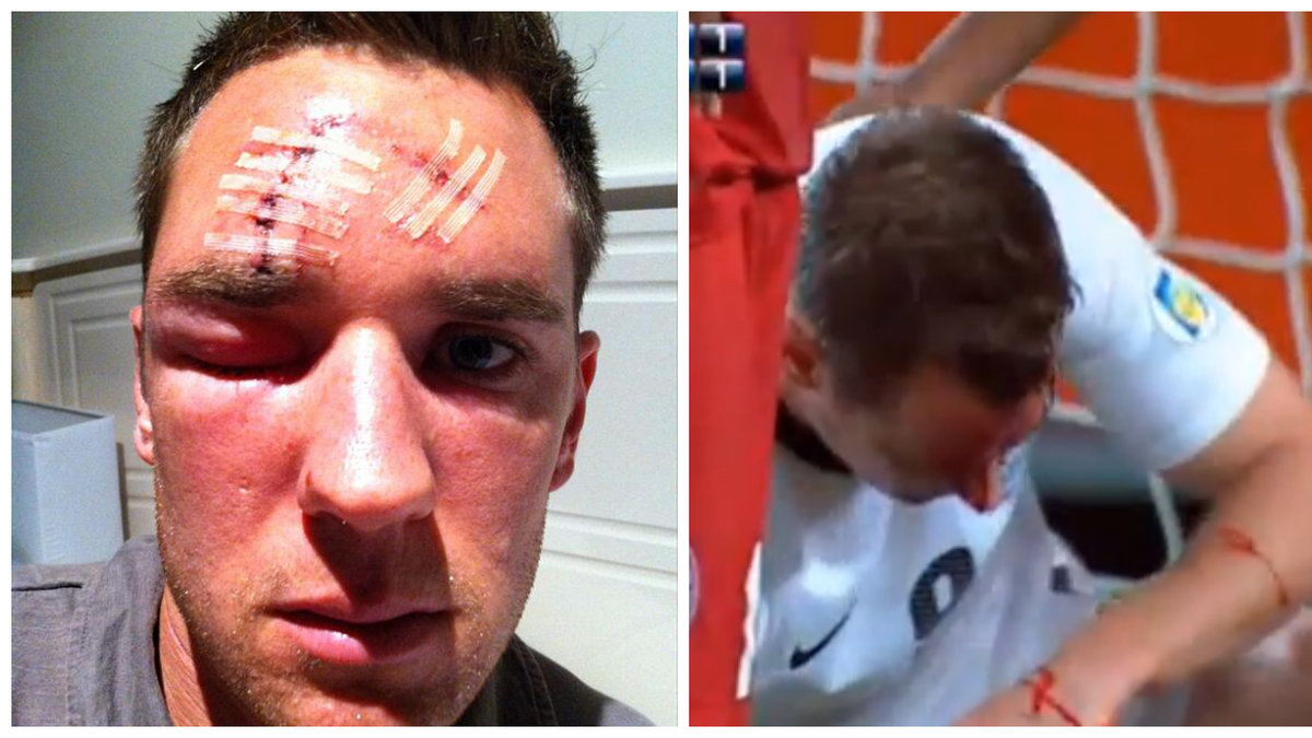 Nya Zeeland-spelaren Shane Smeltz fick efter helgens match sy 15 stygn efter den hänsynslösa attacken från Nya Kaledoniens Tommy Smith.