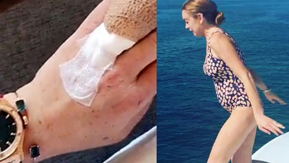 Lindsay Lohan visar upp sin skada på Snapchat. 