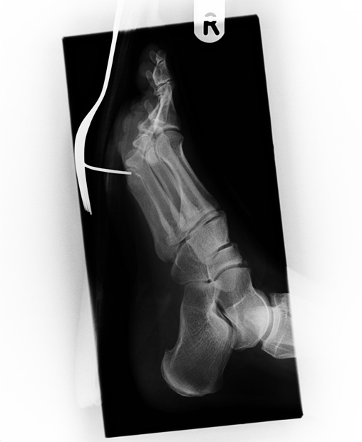 Den här bilden visar hur det kan gå om man råkar trampa på en gaffel. Ouch! Den här bilden visar hur det kan gå om man råkar trampa på en gaffel. Ouch!