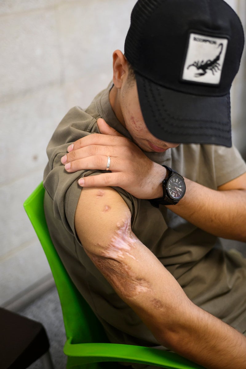 17-årige Amar al-Hams visar upp sin skadade arm i kafeterian på Läkare utan gränsers rehabiliteringsklinik i Amman.
