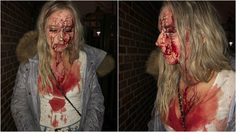 Sophie fick en flaska i huvudet på krogen i Malmö