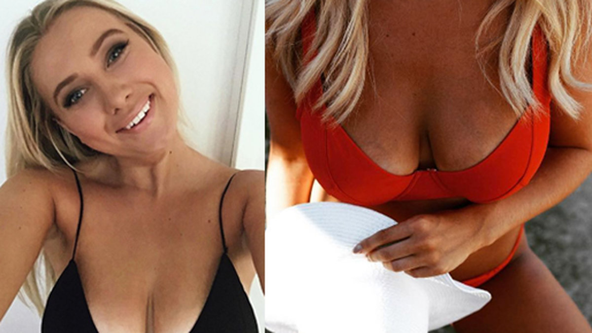 Bloggerskan Hanna "Hannalicious" Friberg genomgick nyligen en bröstförminskning. 