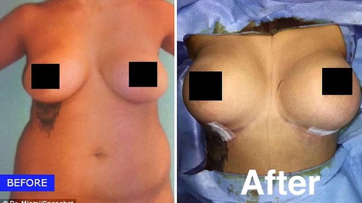 Förvandlingen innefattar bukplastik i form av fettsugning, injektion av fett i rumpan (brazilian buttlift) samt bröstkorrigering. 