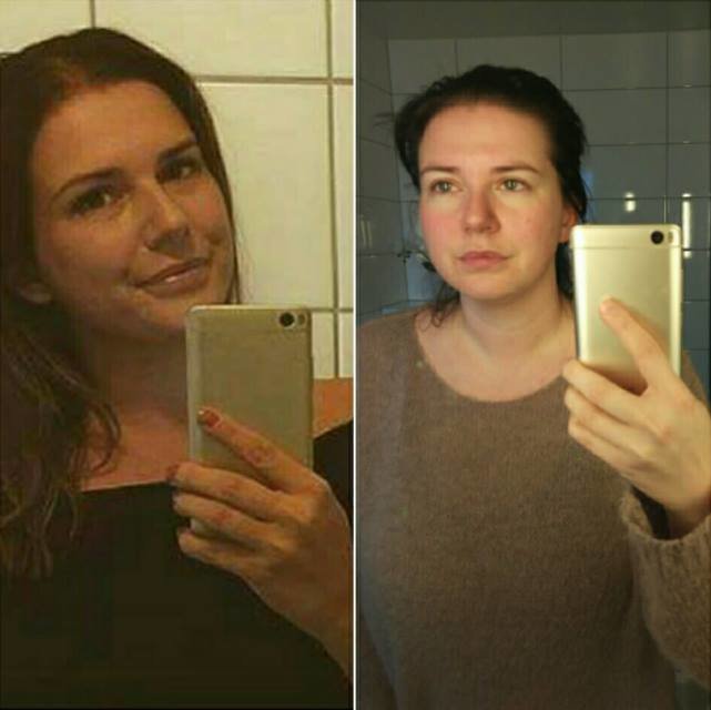 Susanna blev sjuk av bröstimplantatet Susanna blev sjuk av bröstimplantatet