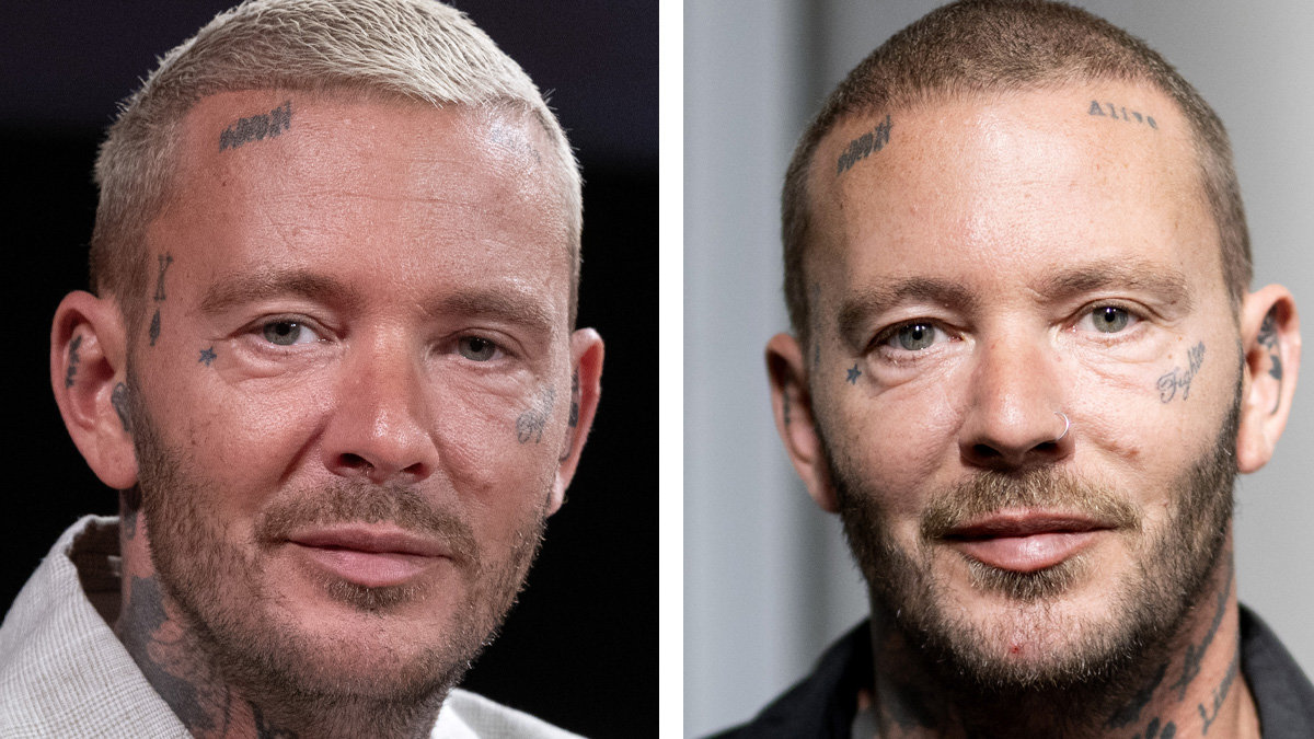 Så mycket kan Joakim Lundells nya skönhetsoperation kosta