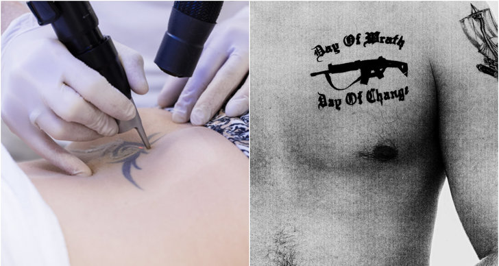 Tatueringar, Borttagning