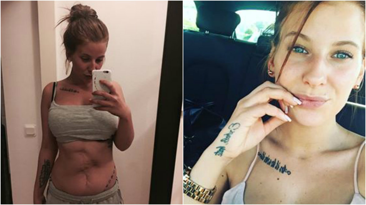 Linn föddes med ovanlig missbildning – nu visar hon stolt upp sitt ärr