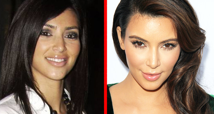 Bild, Operation, Kim Kardashian, Före- och efterbild