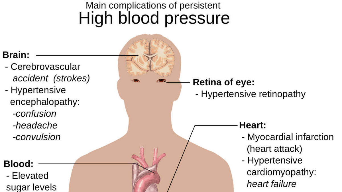 Vad som kan hända när man har högt blodtryck.