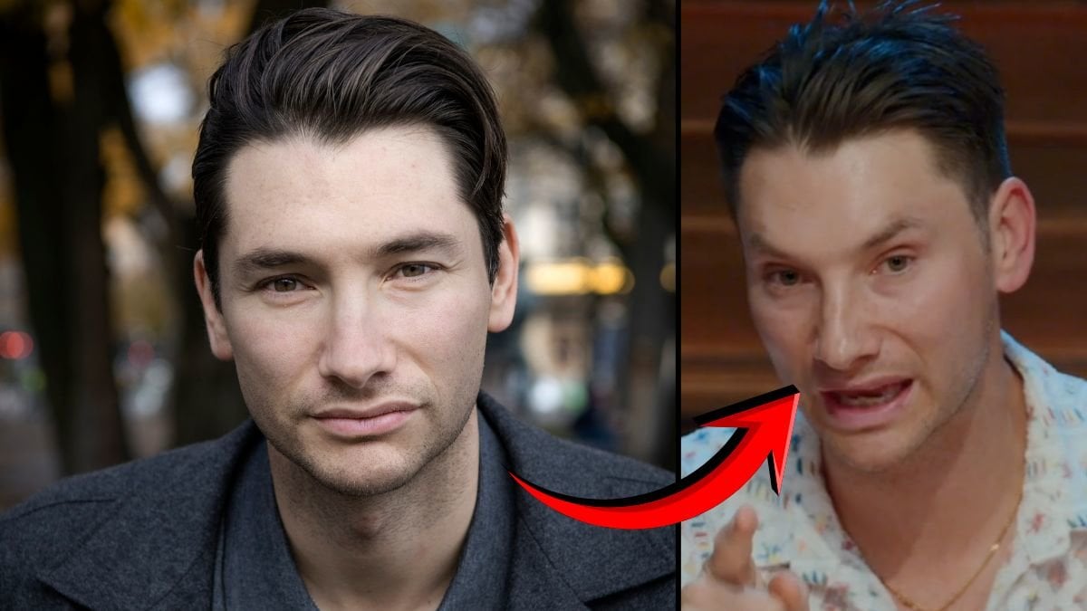 Alexander Pärleros: "Därför ser mitt ansikte ut som det gör"