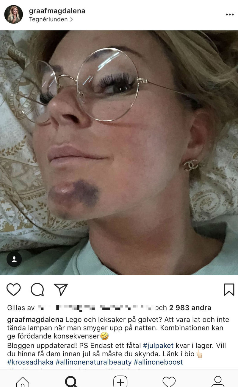 Magdalena Graaf visar upp ett stort blåmärke på hakan Magdalena Graaf visar upp ett stort blåmärke på hakan