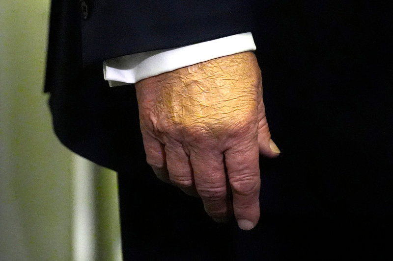 Trumps hand med ett tjockt lager smink. Foto: Mark Schiefelbein /AP/TT