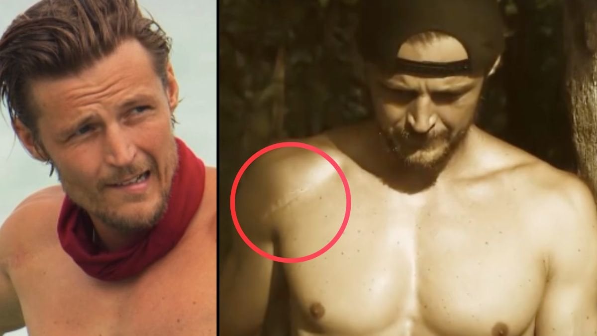 Så fick Robinson-Jonas sitt ärr: 