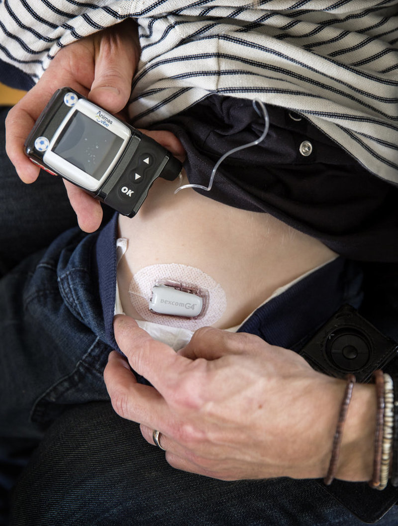 En insulinpump som är en av metoderna för att tillföra insulin för diabetiker. Läs mer om tecken på diabetes här. En insulinpump som är en av metoderna för att tillföra insulin för diabetiker. Läs mer om tecken på diabetes här.