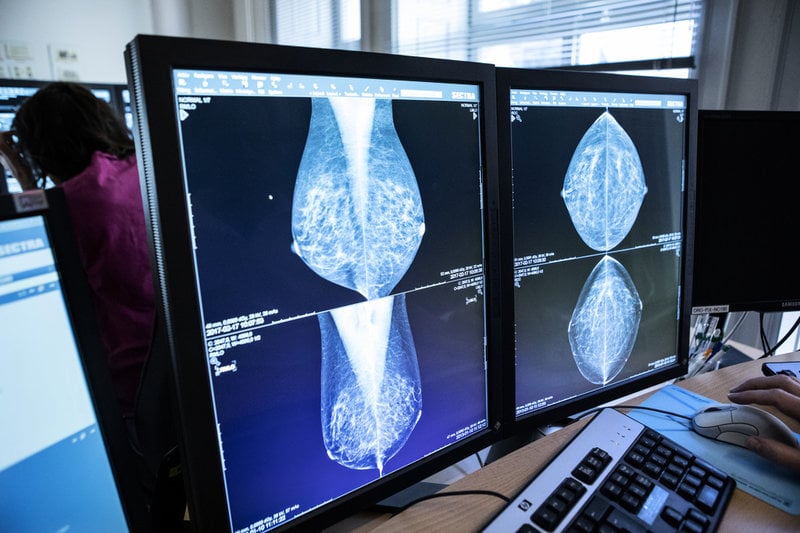 Vissa kvinnor friskförklarades felaktigt efter sin mammografi på grund av fel i en programvara, utan att deras bilder granskats av radiologer. Arkivbild.