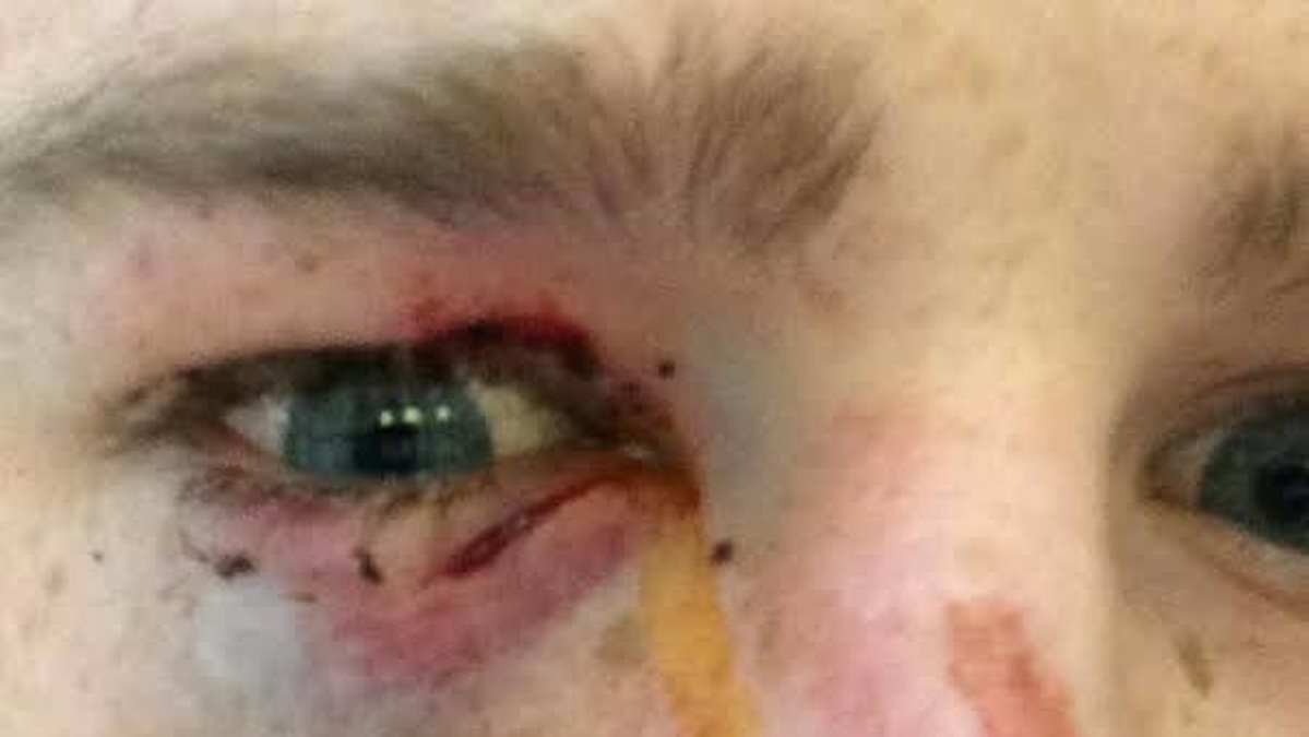 Han fick skador runt hela ögat och fraktur i ansiktet. 
