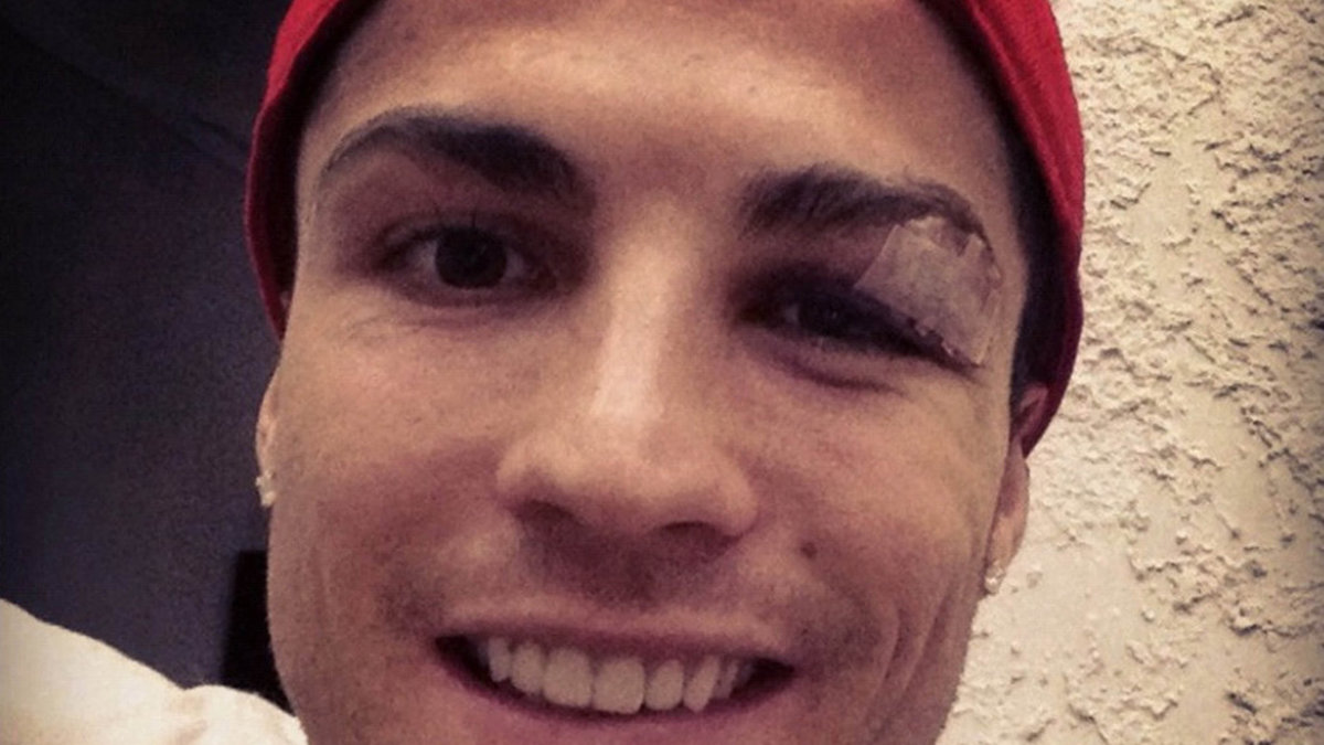 Ronaldo har ett blått öga. 