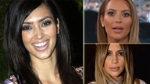 Kim Kardashian före och efter sina många ingrepp och operationer.