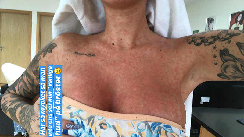 Paulina Paow Danielsson om sin psoriasis Paulina Paow Danielsson om sin psoriasis