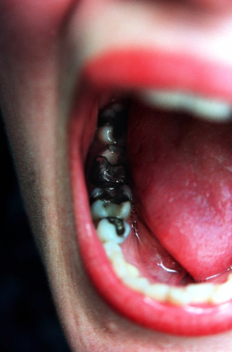 En amalgamfyllning i tänderna består till hälften av kvicksilver – ett av de farligaste miljögifterna. Arkivbild.