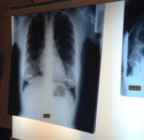 Röntgenbild som visar en torso Röntgenbild som visar en torso