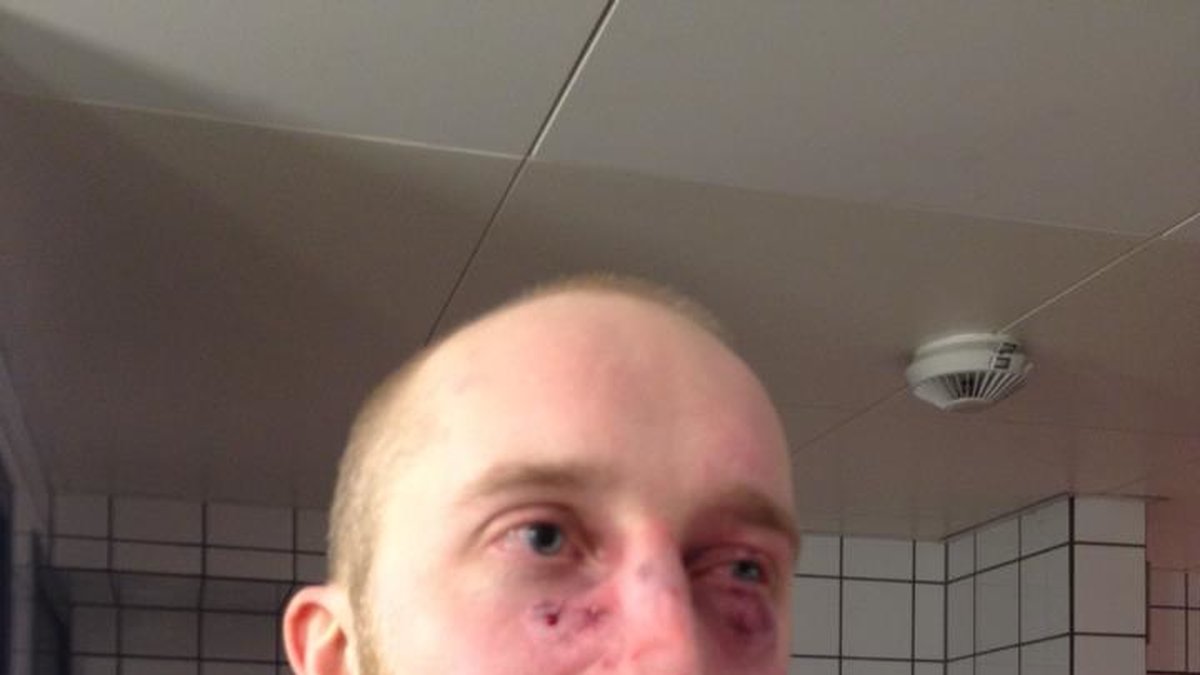 Filip Wennerlunds blodiga ansikte har lett till stora reaktioner på Facebook.