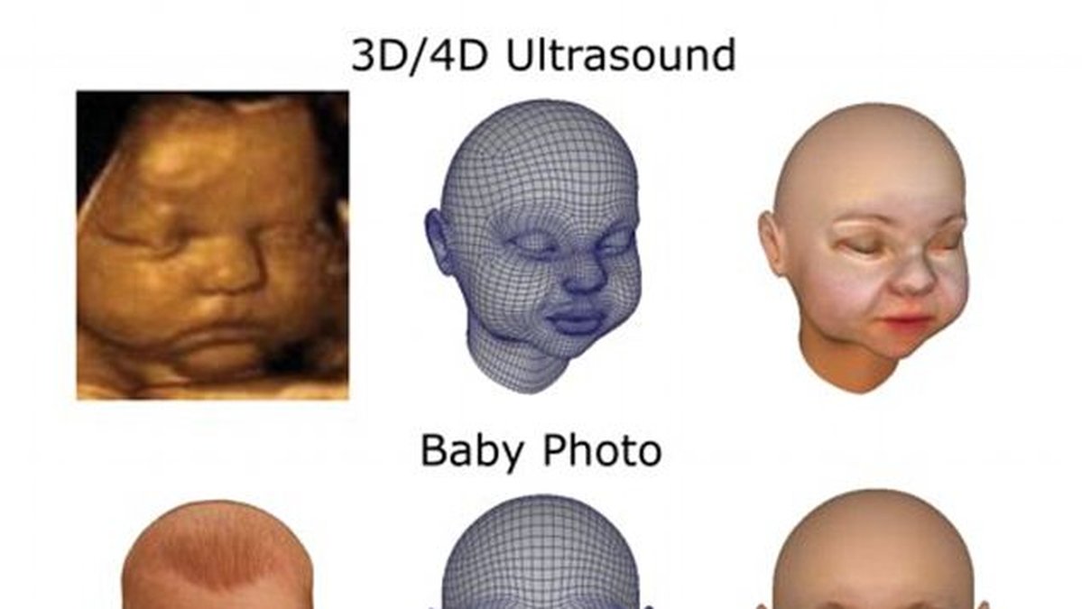 Efter ultraljud görs en 3d-modell av fostret.