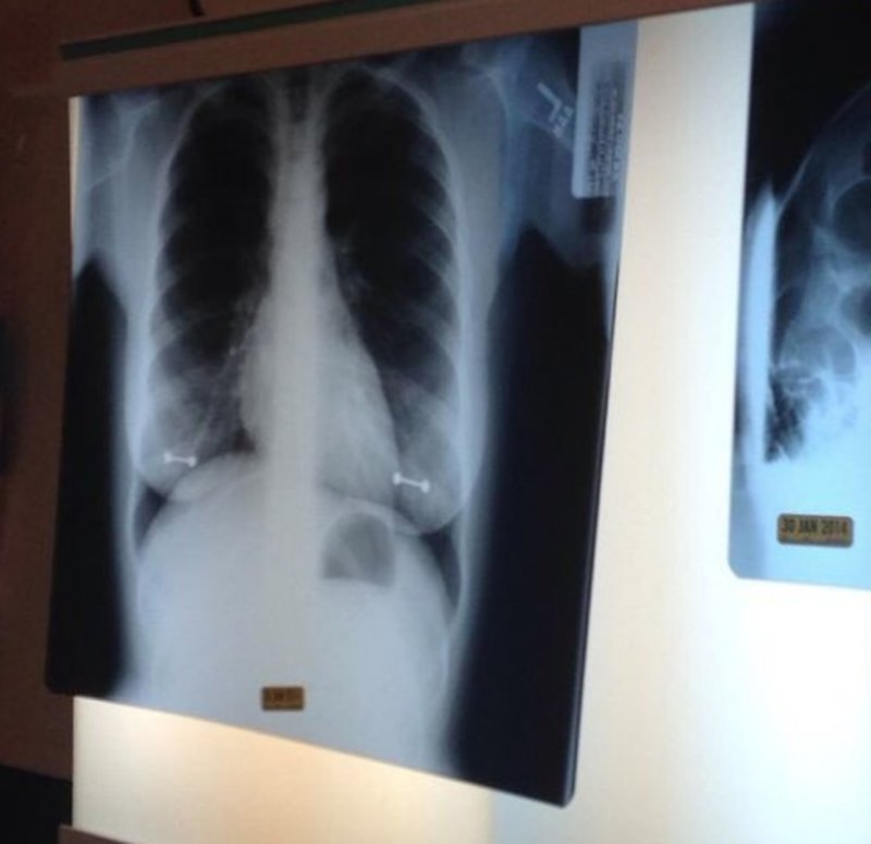 Röntgenbild som visar en torso Röntgenbild som visar en torso